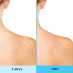 Differin Acne-Clearing Body Spray chest application shown for balanced treatment.