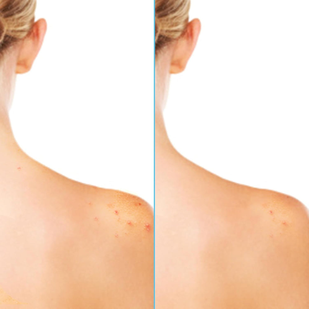 Differin Acne-Clearing Body Spray reduces oil and minimizes pores.