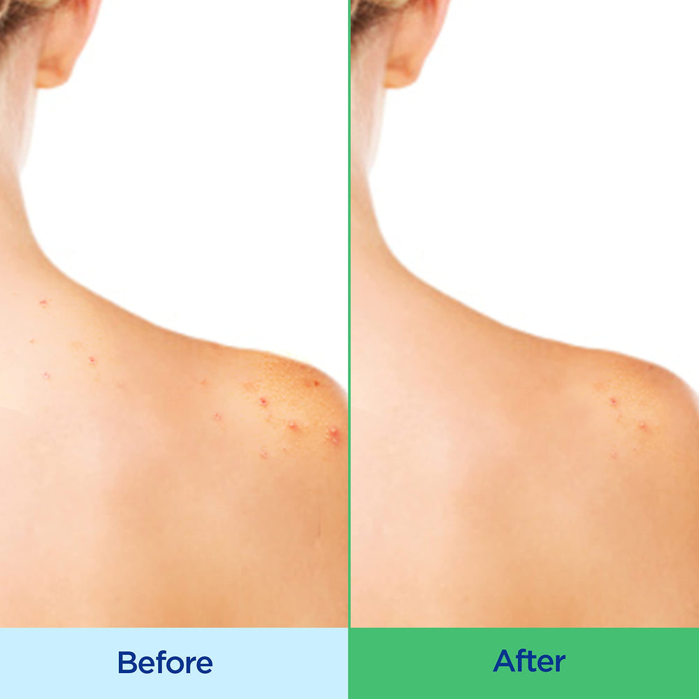 Differin Acne-Clearing Body Wash applied to back and shoulders for targeted cleansing.