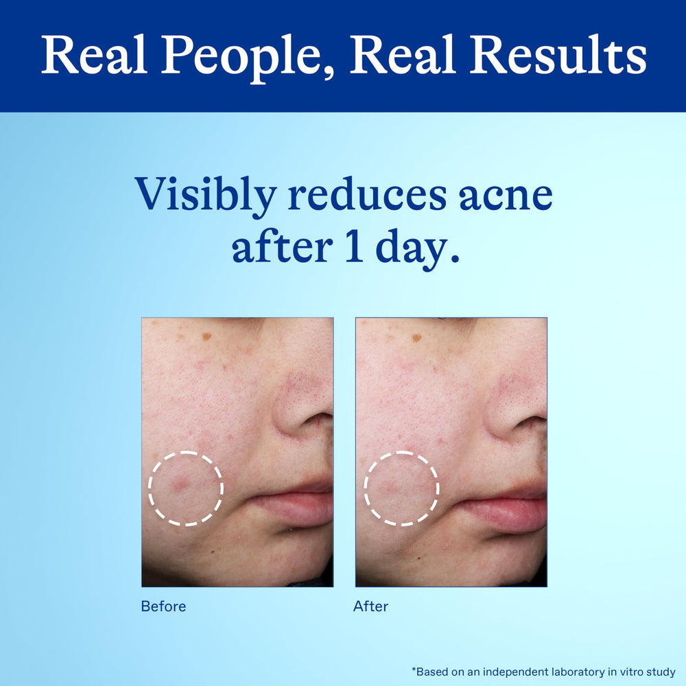 Differin spot treatment in use during skincare routine after cleansing