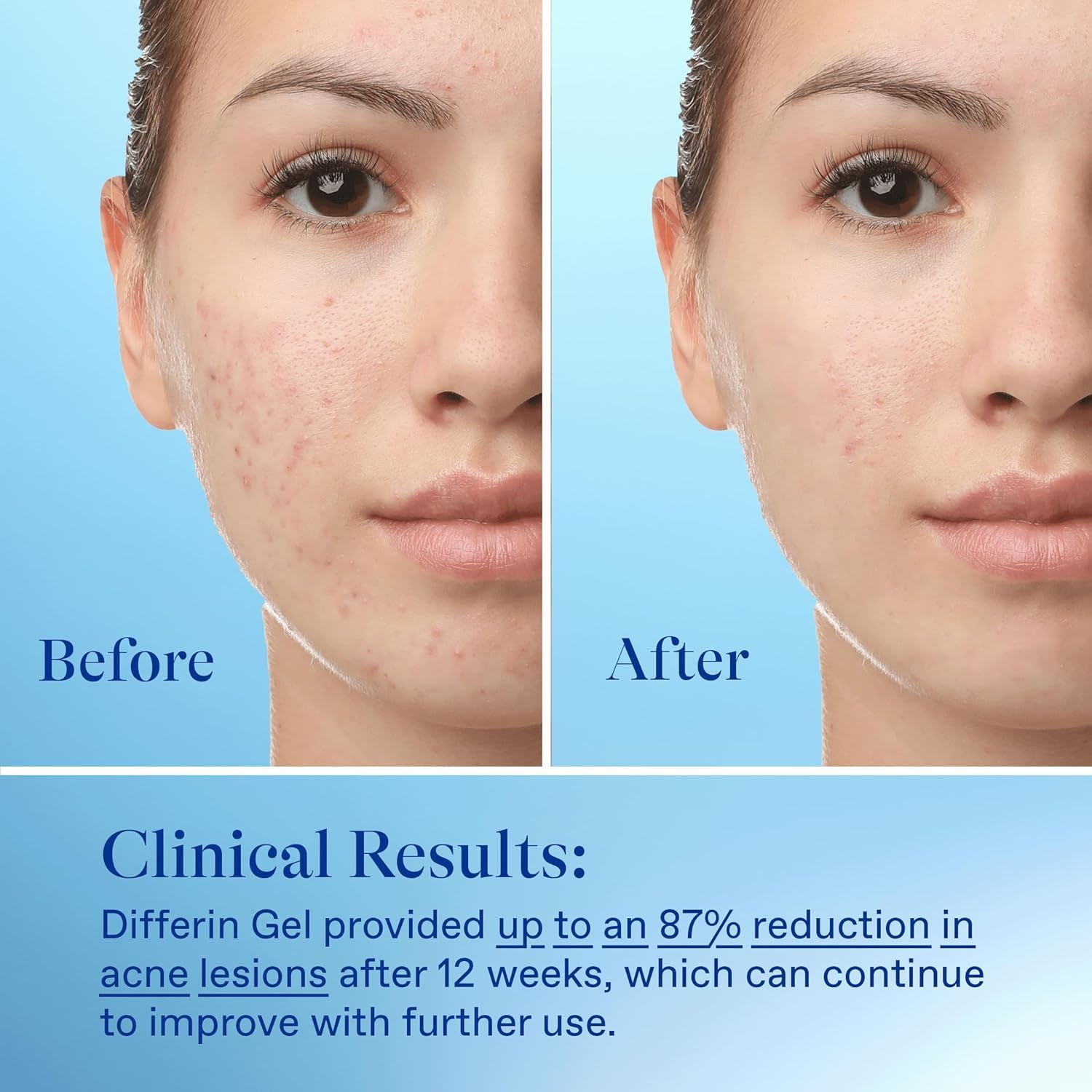 Clinical study image hints at potential improvements after 12 weeks with consistent Differin use.