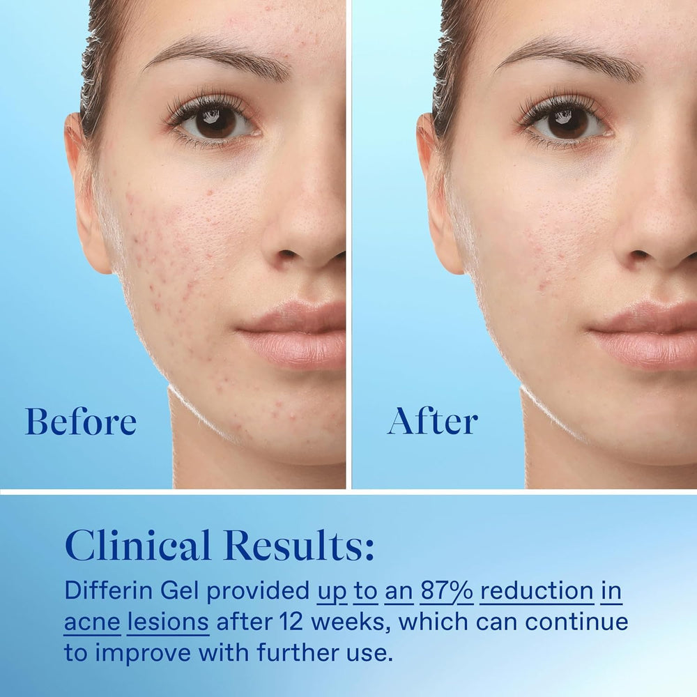Clinical study image hints at potential improvements after 12 weeks with consistent Differin use.