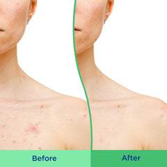 Differin body scrub is easy to apply on the back, shoulders, and chest.