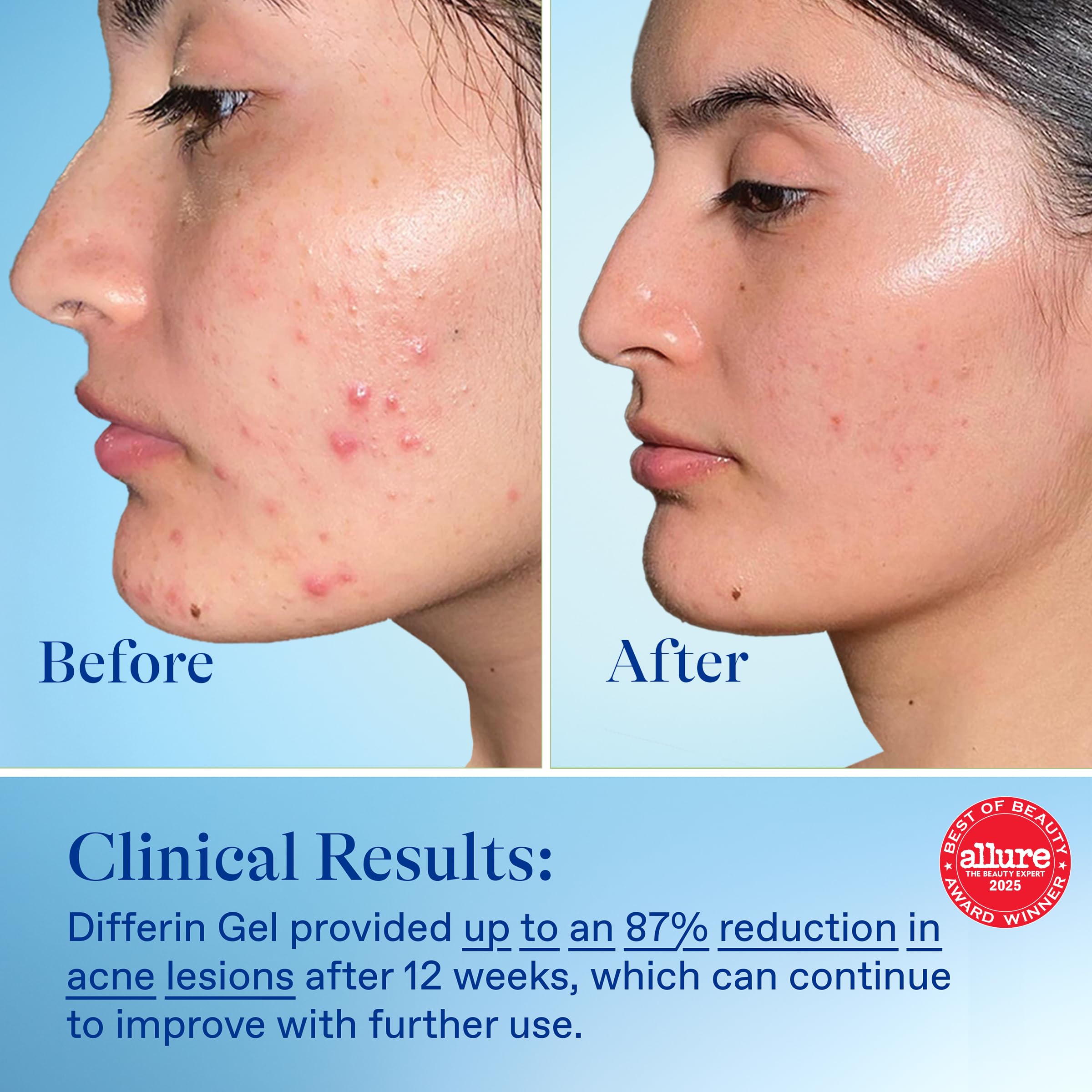 Differin clinical results note improvements after 12 weeks.