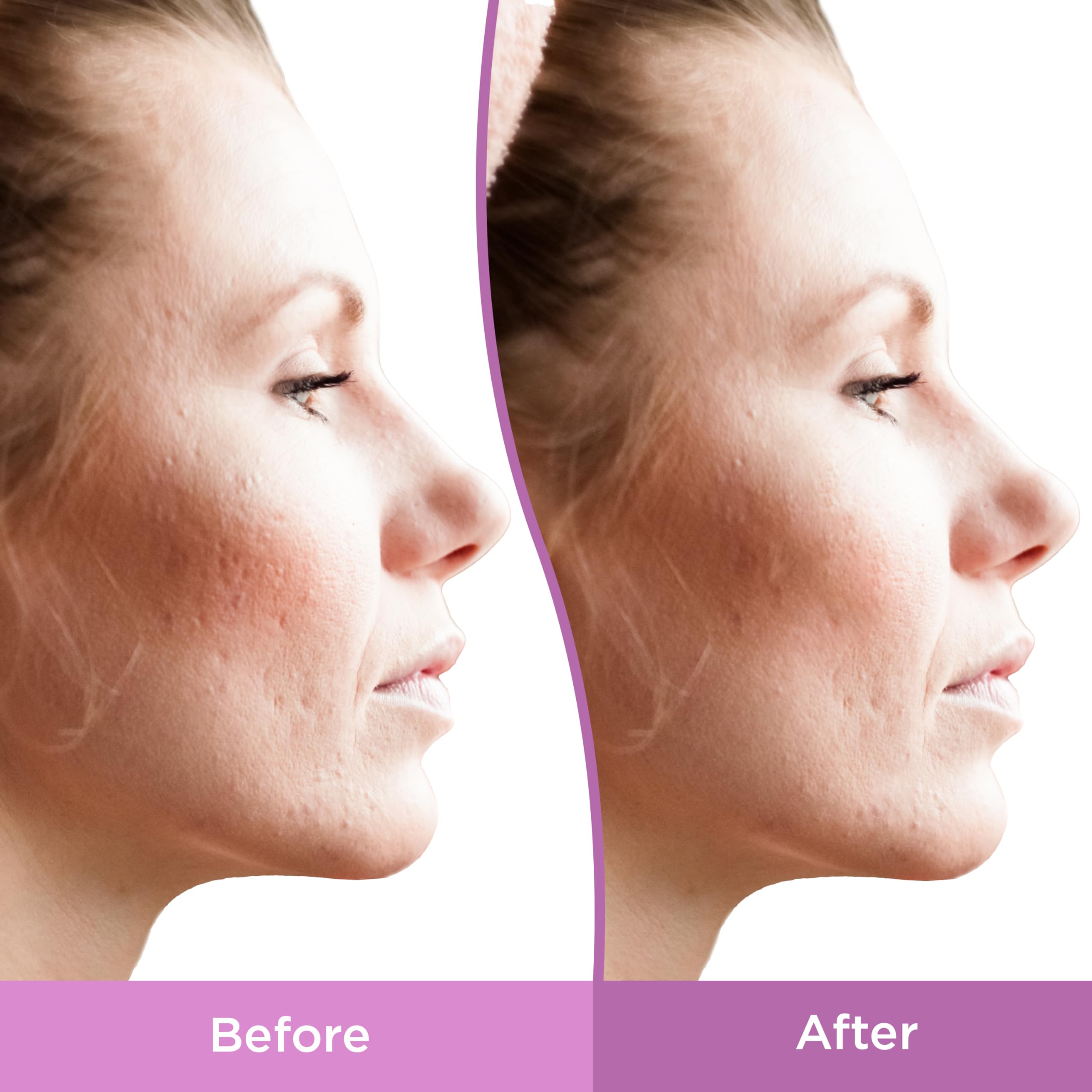 Differin Resurfacing Scar Gel supports daily care for consistent results.