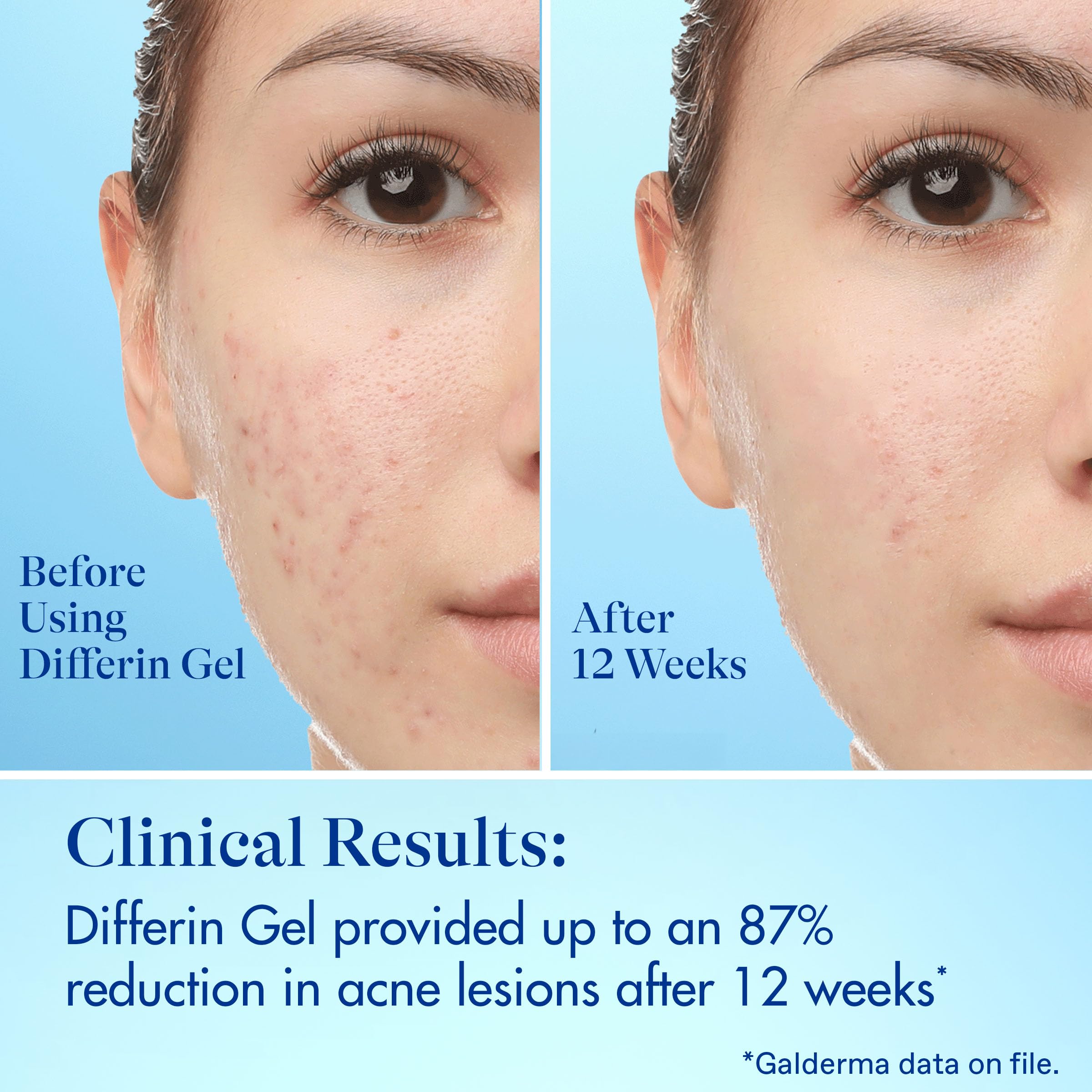 Morning skincare with Differin patch on a breakout-ready face