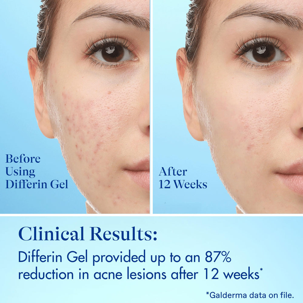 Morning skincare with Differin patch on a breakout-ready face
