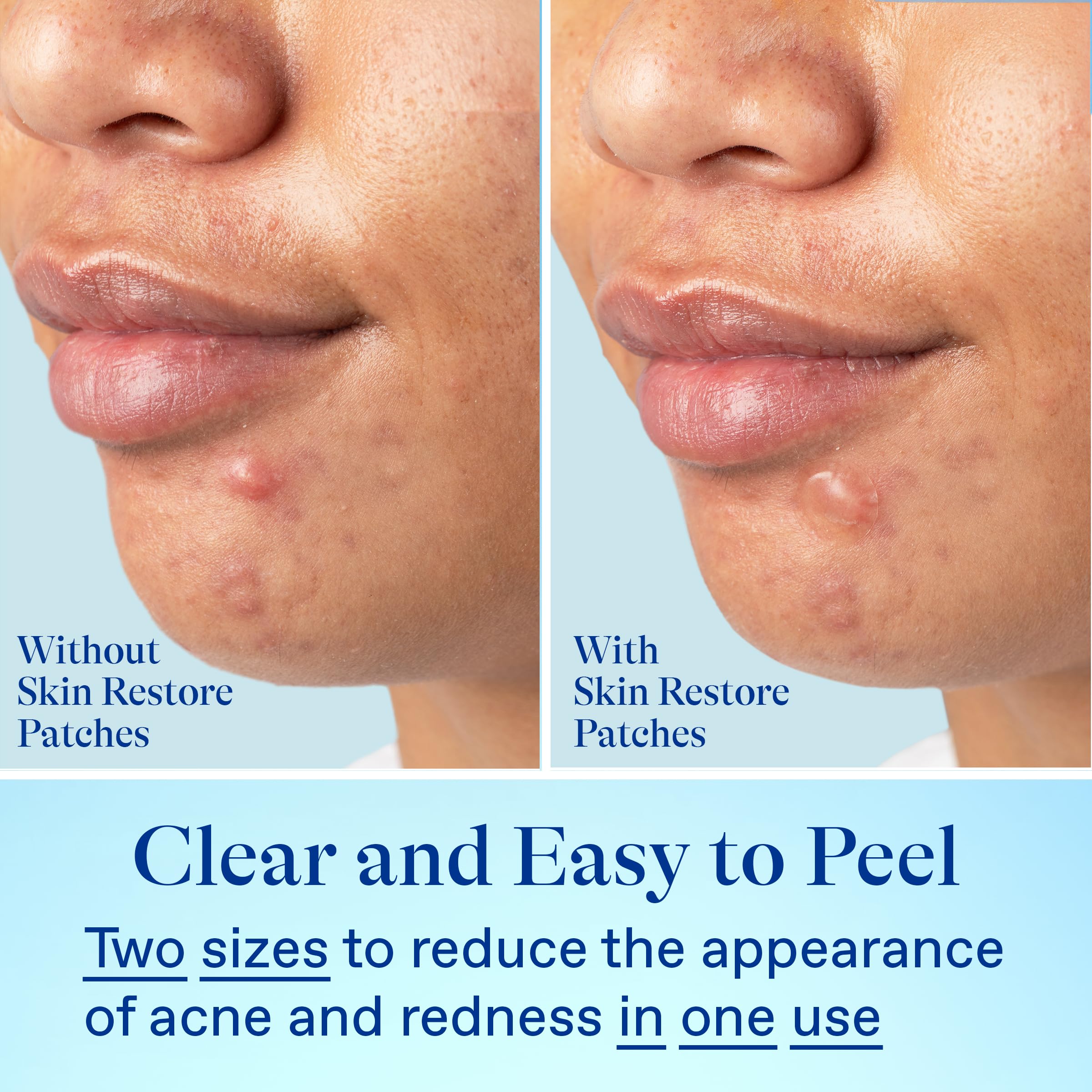 Patches worn under makeup for discreet, waterproof acne care during the day