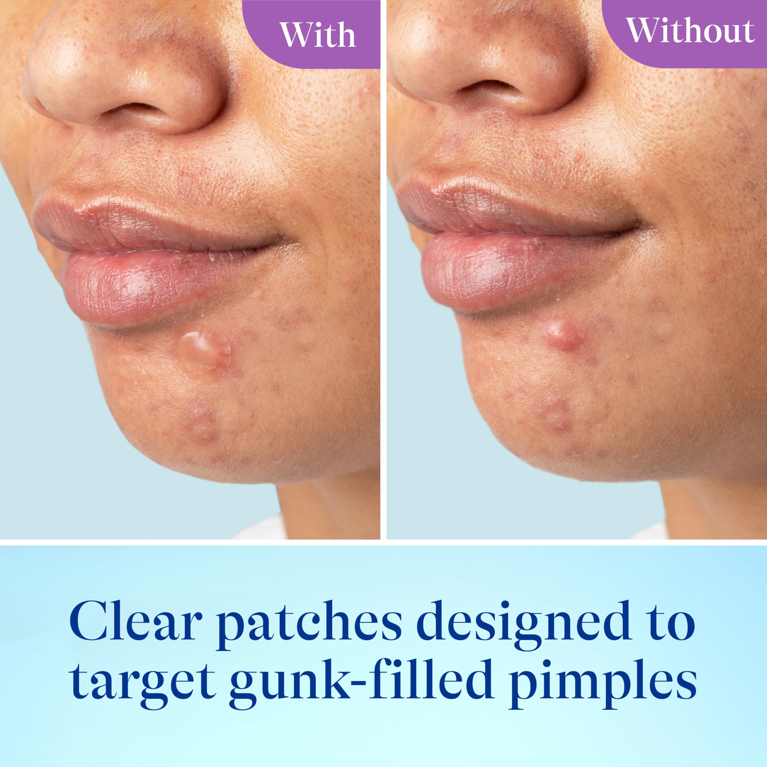 Differin Power Patch large patches designed for bigger breakouts with secure adhesion.