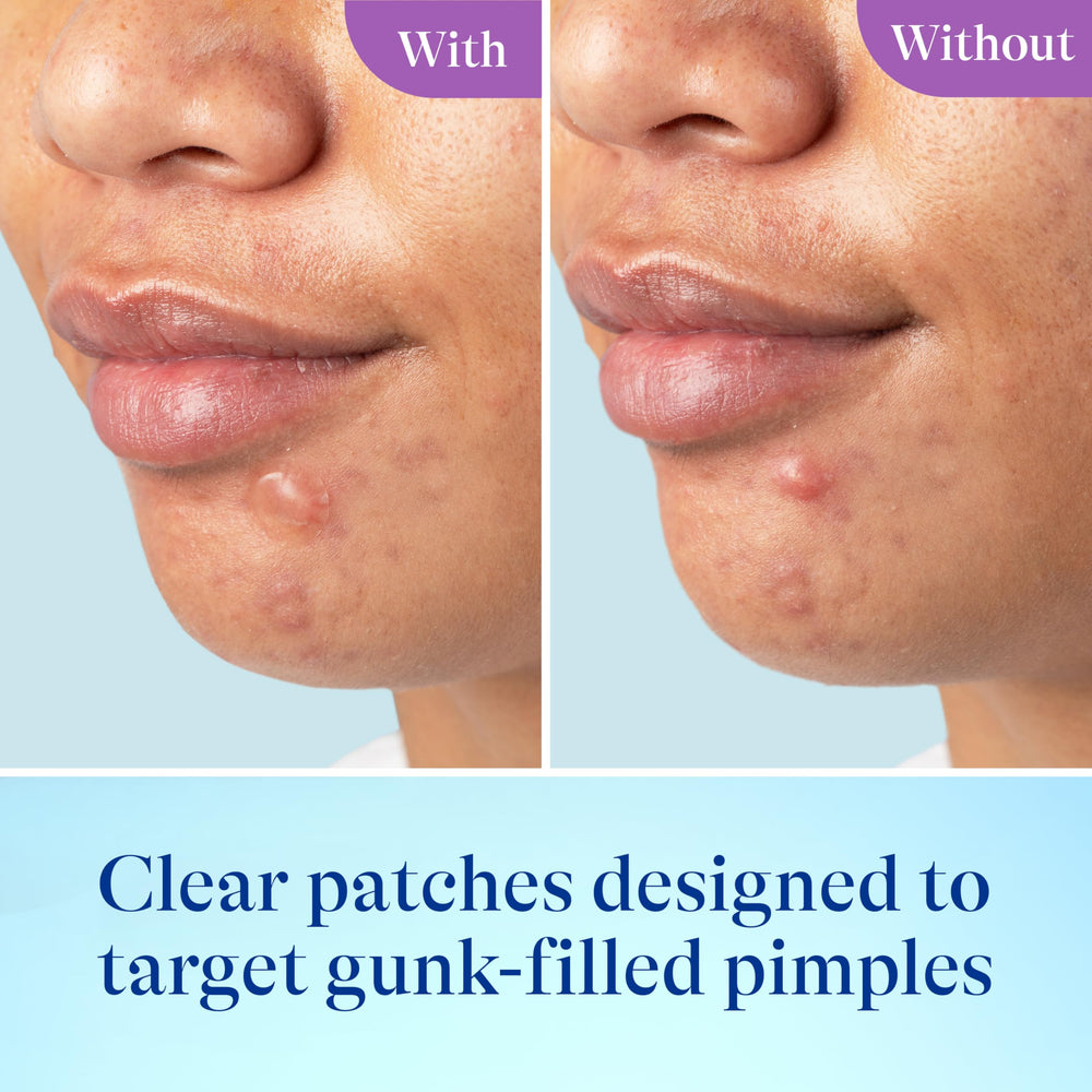 Differin Power Patch large patches designed for bigger breakouts with secure adhesion.