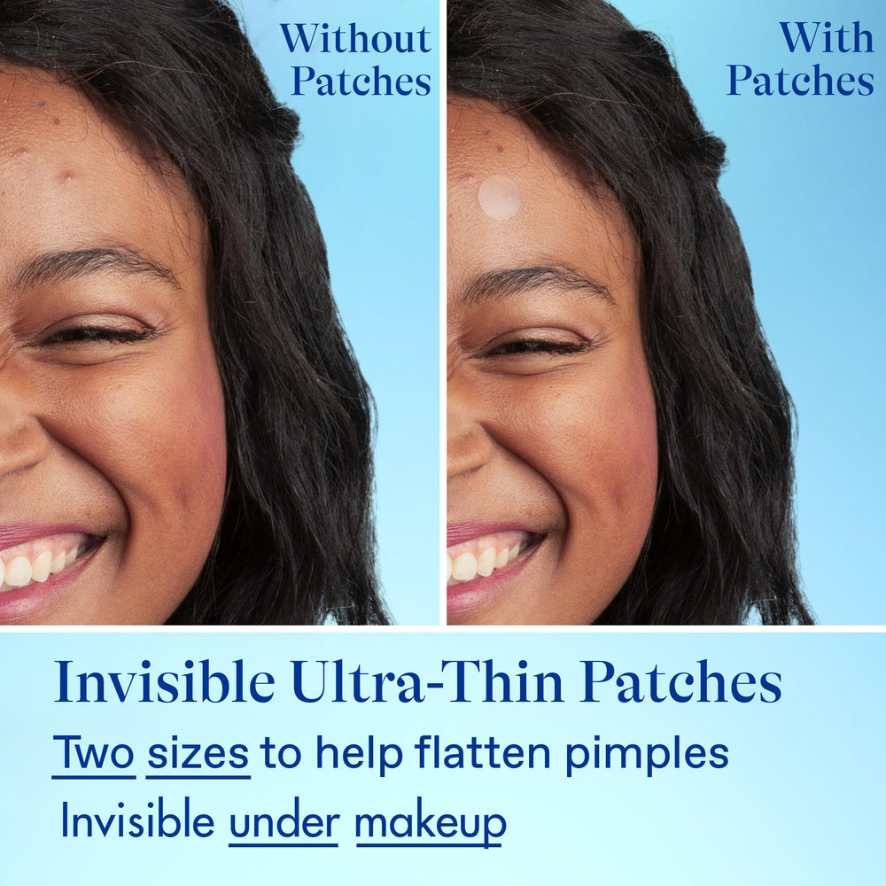Unboxing Differin acne fighter pack showing tube and 36 patches