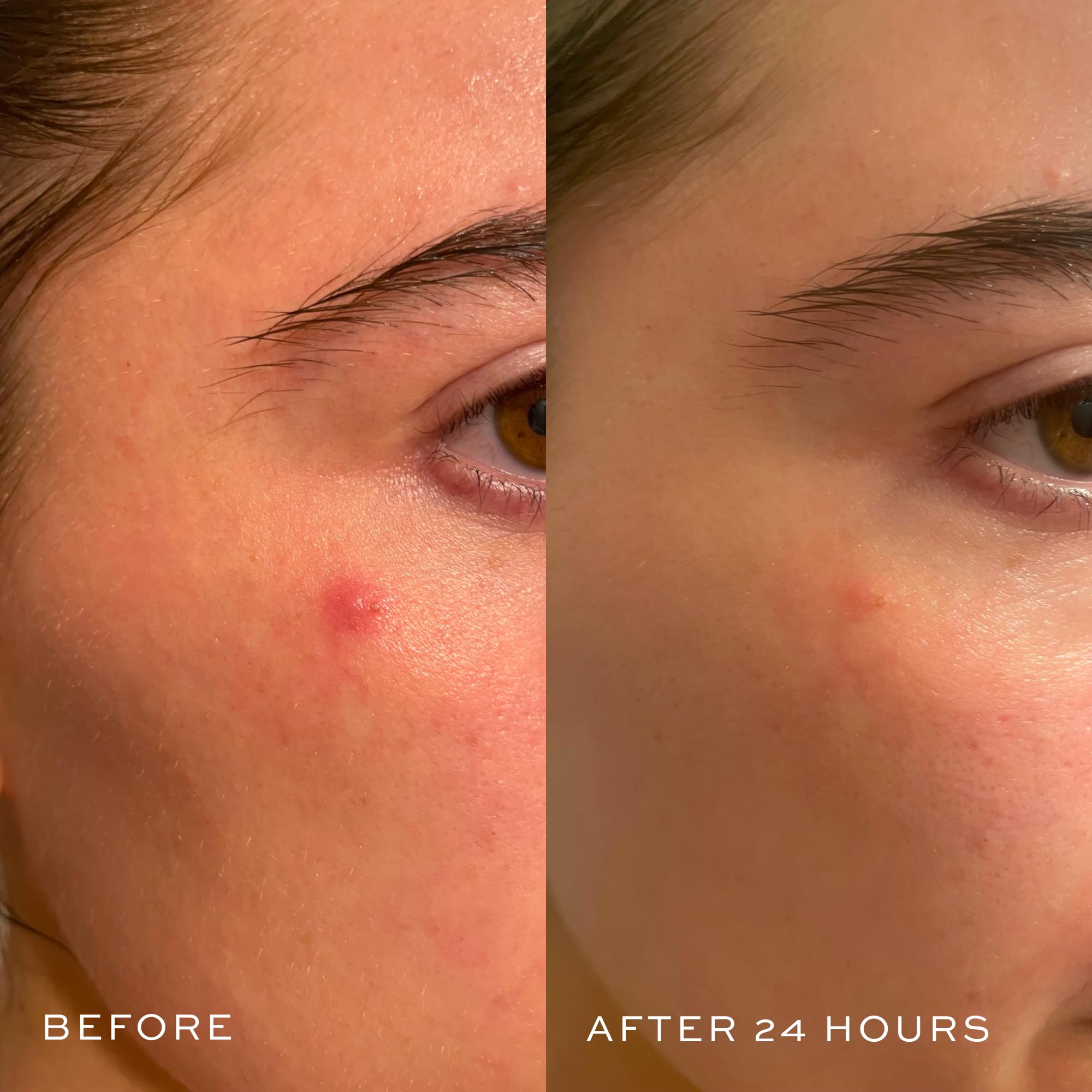Pack shot showing DIME Power Patch for blemish care on the go.