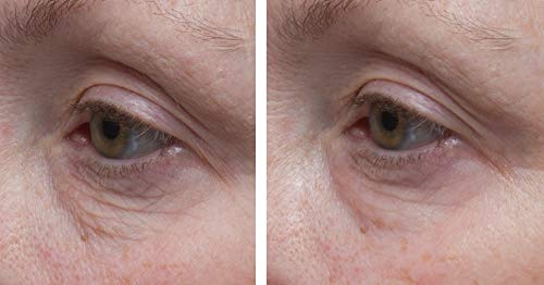 Dr. Denese SkinScience firming eye cream being applied under the eye to reduce puffiness.