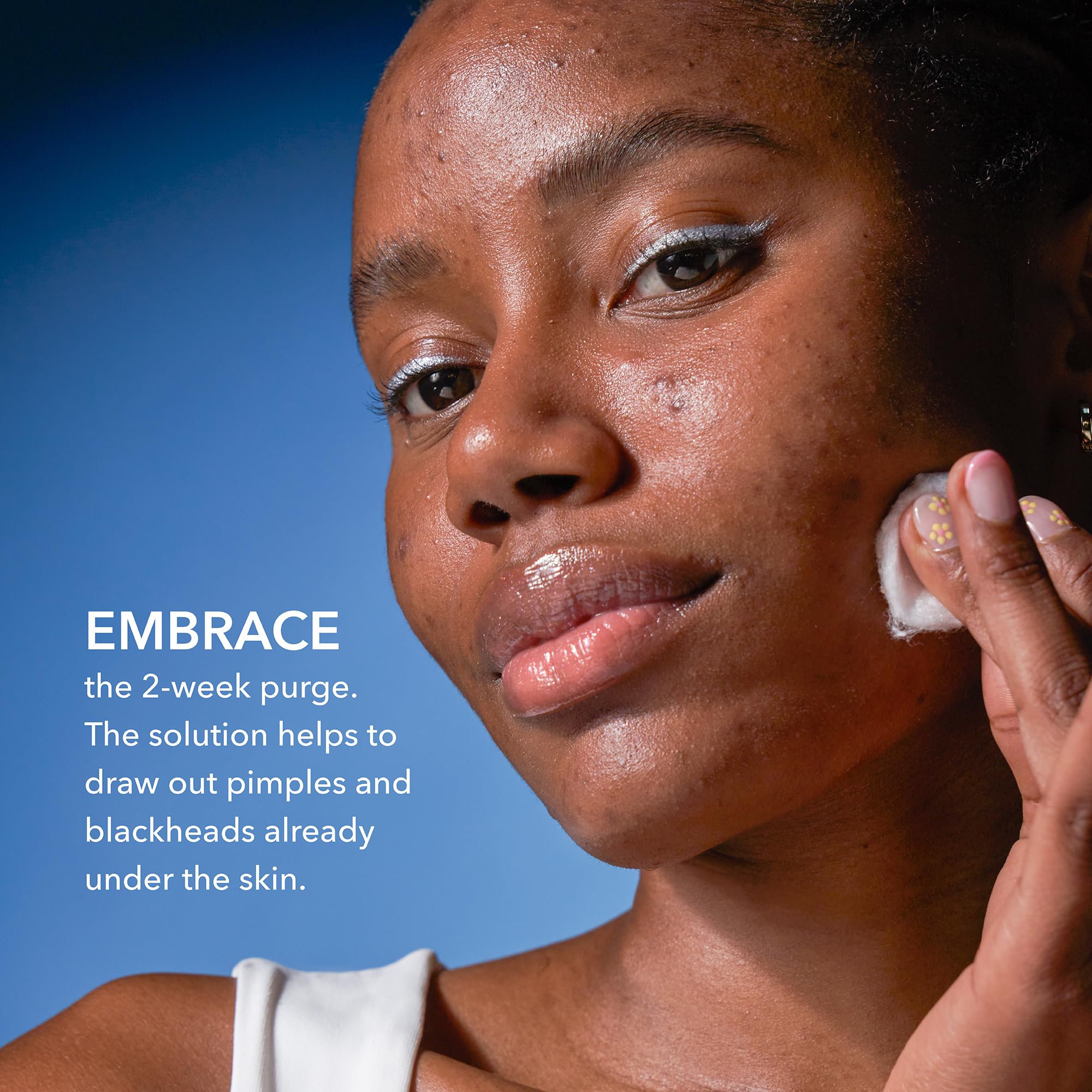 Azelaic-acid closeup notes post-acne discoloration fading potential