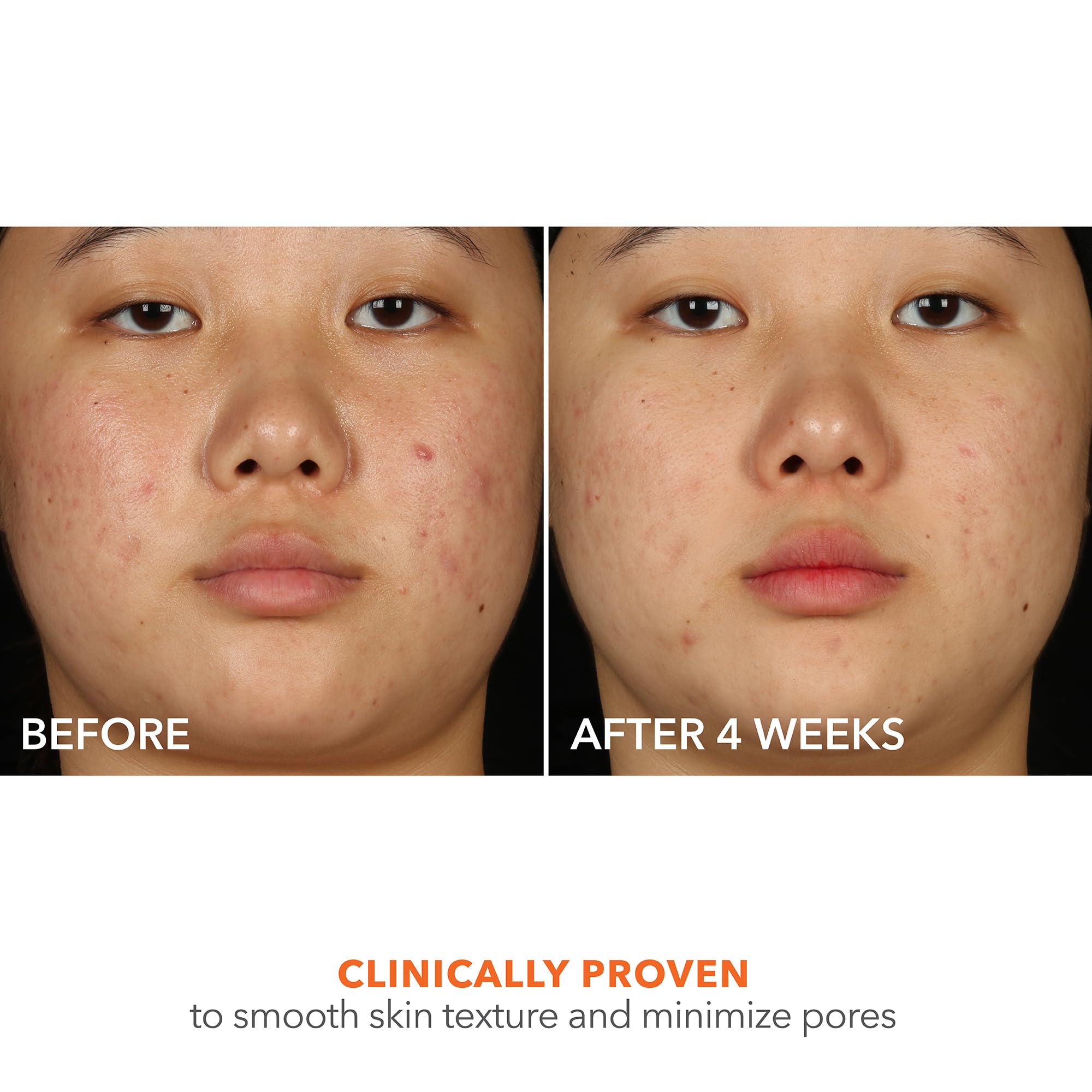 Texture-application on skin closeup suggests smoothing and even tone with Alpha Beta