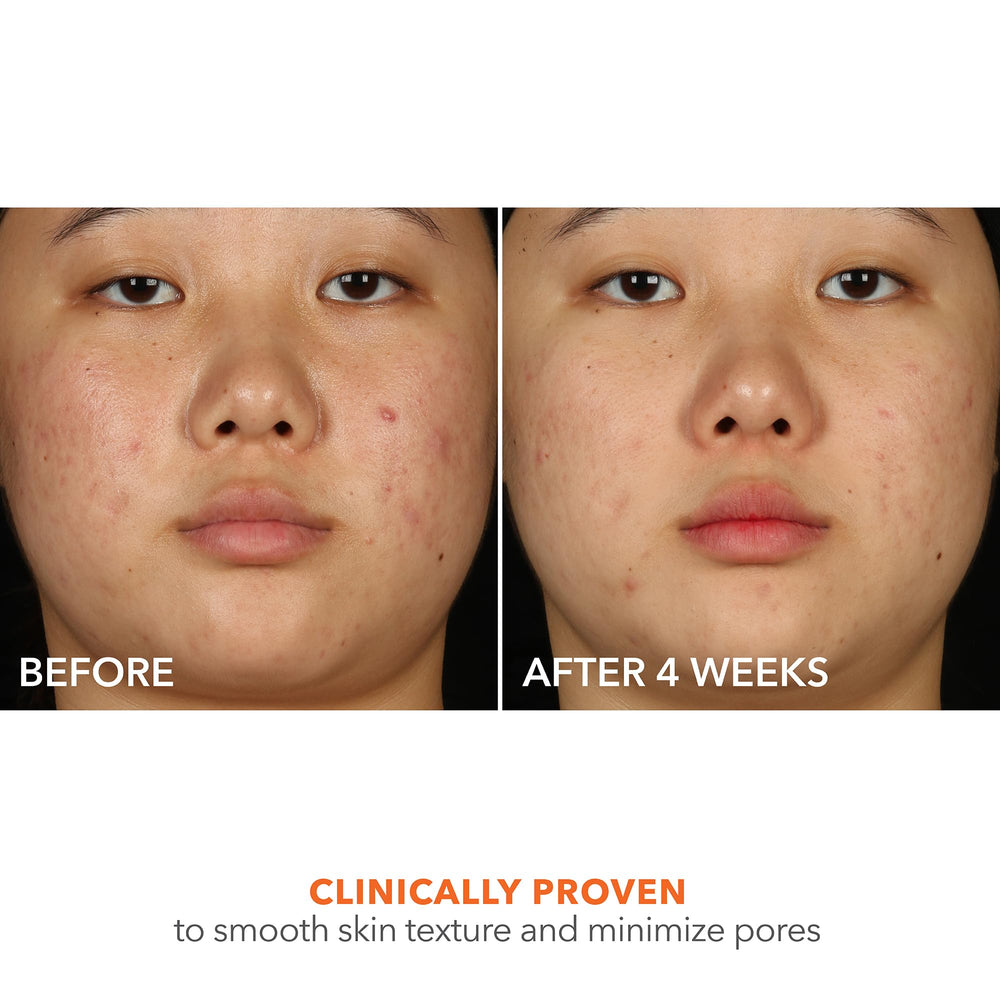 Texture-application on skin closeup suggests smoothing and even tone with Alpha Beta