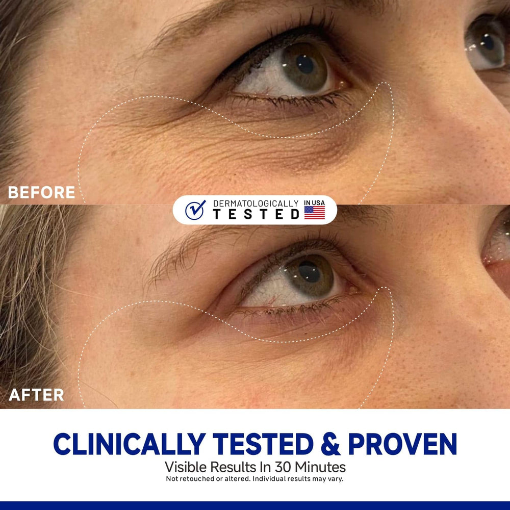 Dr Vincent peptide jojoba under-eye patches applied on eye for instant refreshment.