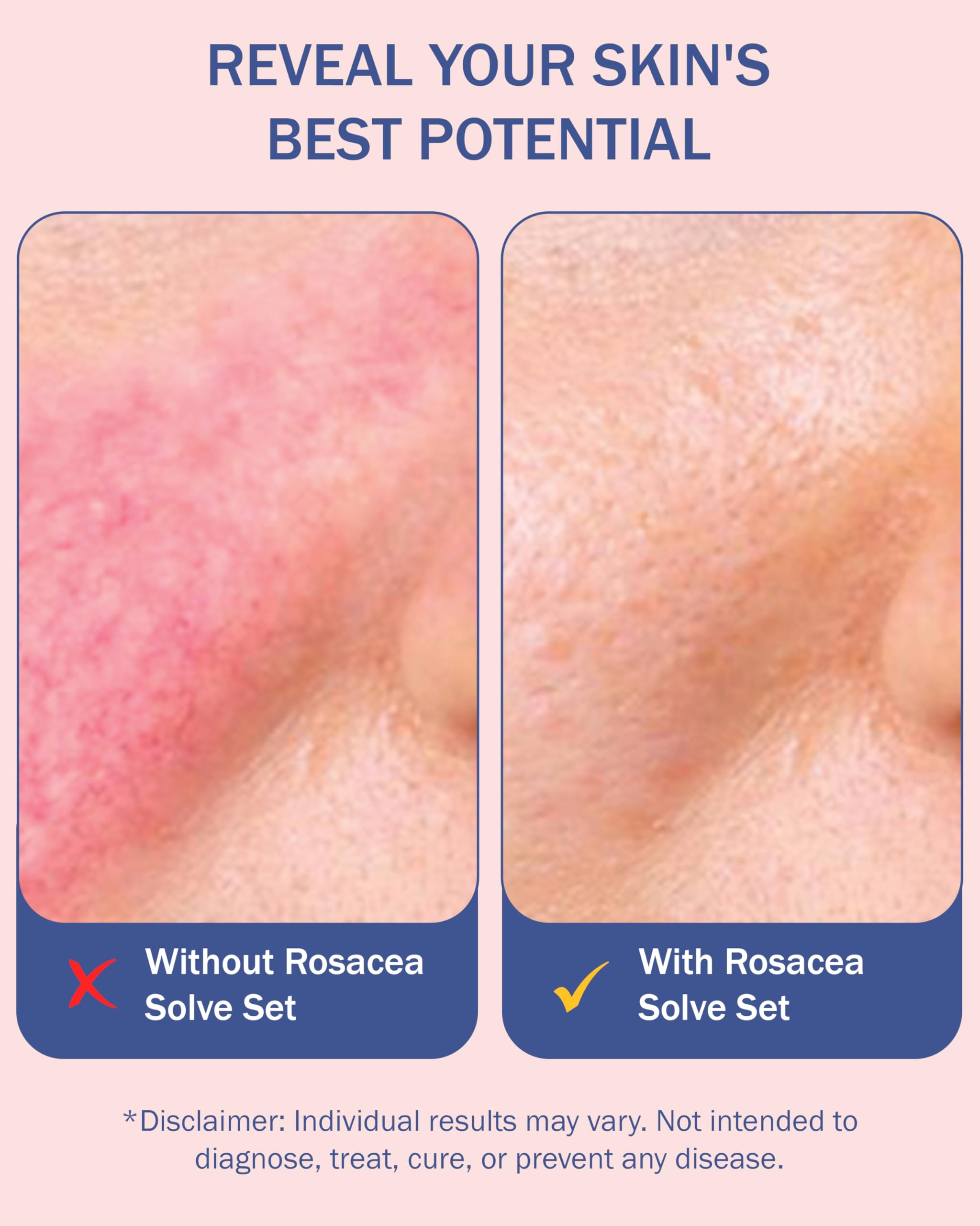 e70 rosacea serum bottle highlighting 10% azelaic acid and niacinamide