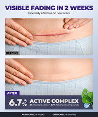 EASEWAVE scar cream packaging front shows trusted brand and product details for confidence