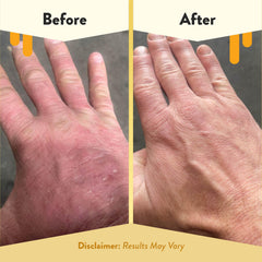 ECZEMA HONEY Gentle Foaming Hand Soap on hands shows moisturized, comfortable skin after washing