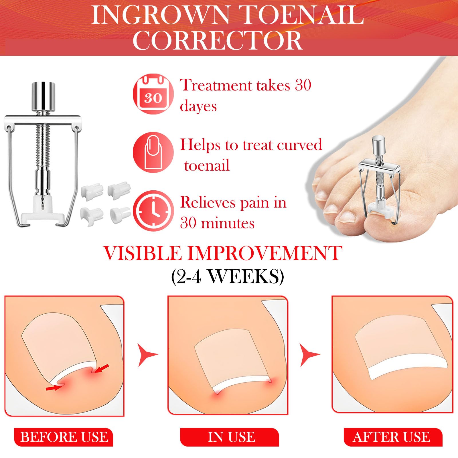 ELALRAU toenail correct patch illustration shows discreet, on-the-go support for daily wear