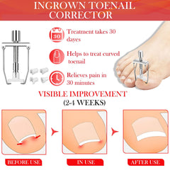 ELALRAU toenail correct patch illustration shows discreet, on-the-go support for daily wear