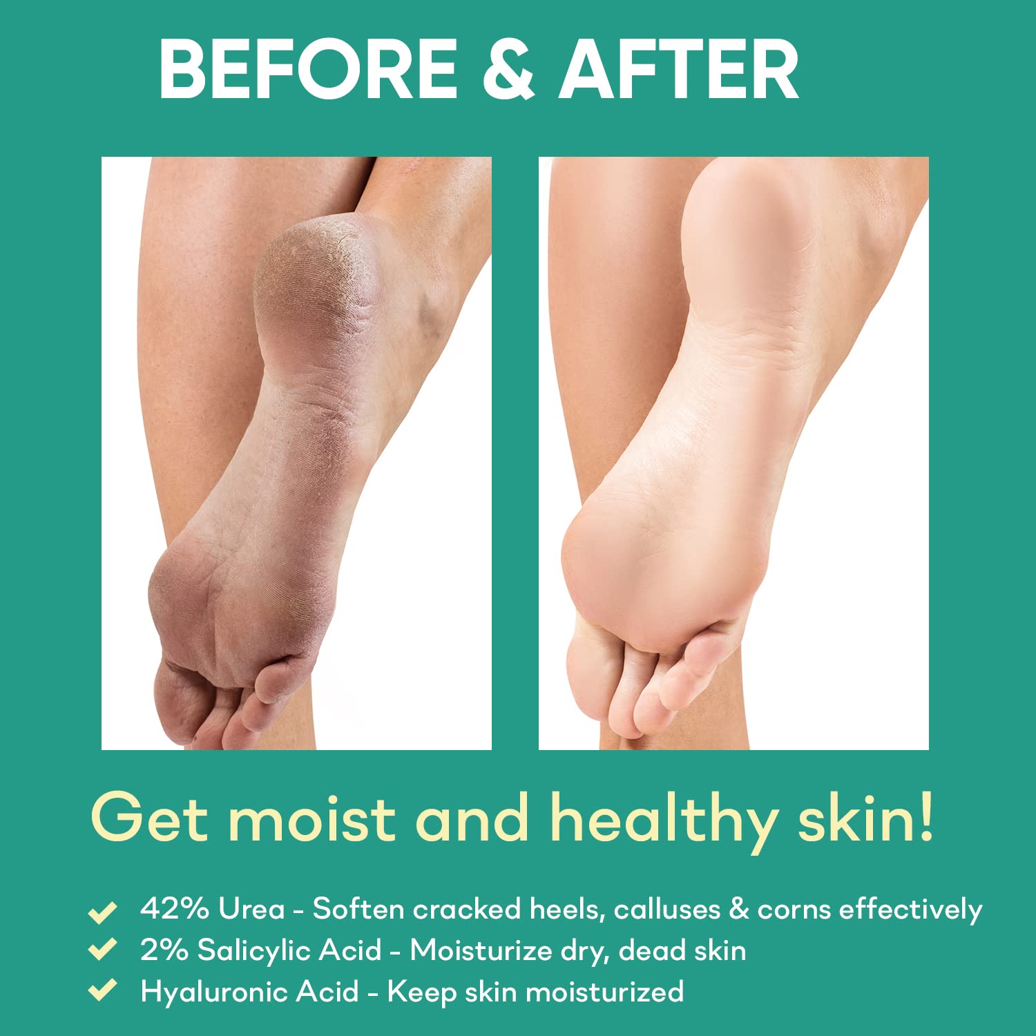 Feet with Ellocy gel being applied to rough heels for smoothness