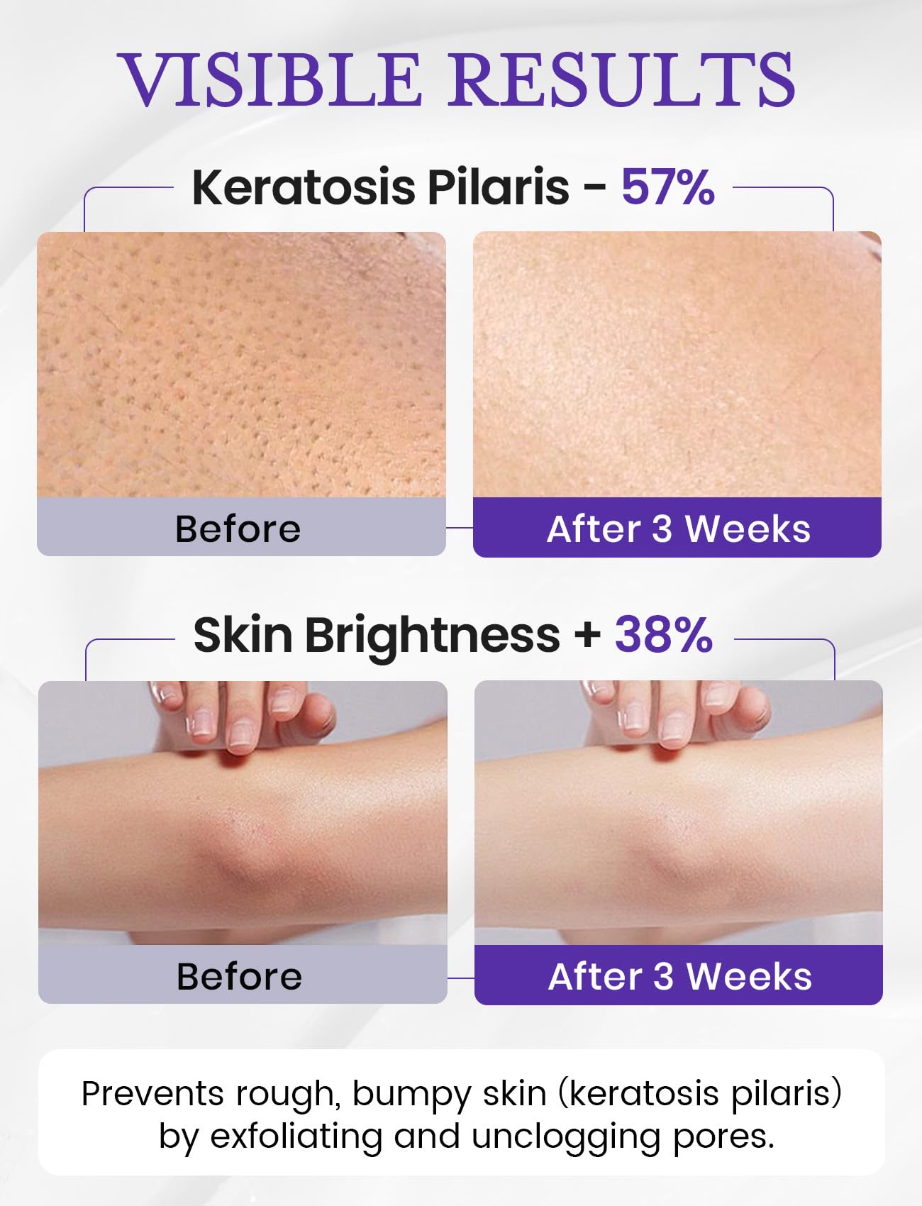 Elvira KP Bump Eraser features Niacinamide and Vitamin C for brighter-looking skin