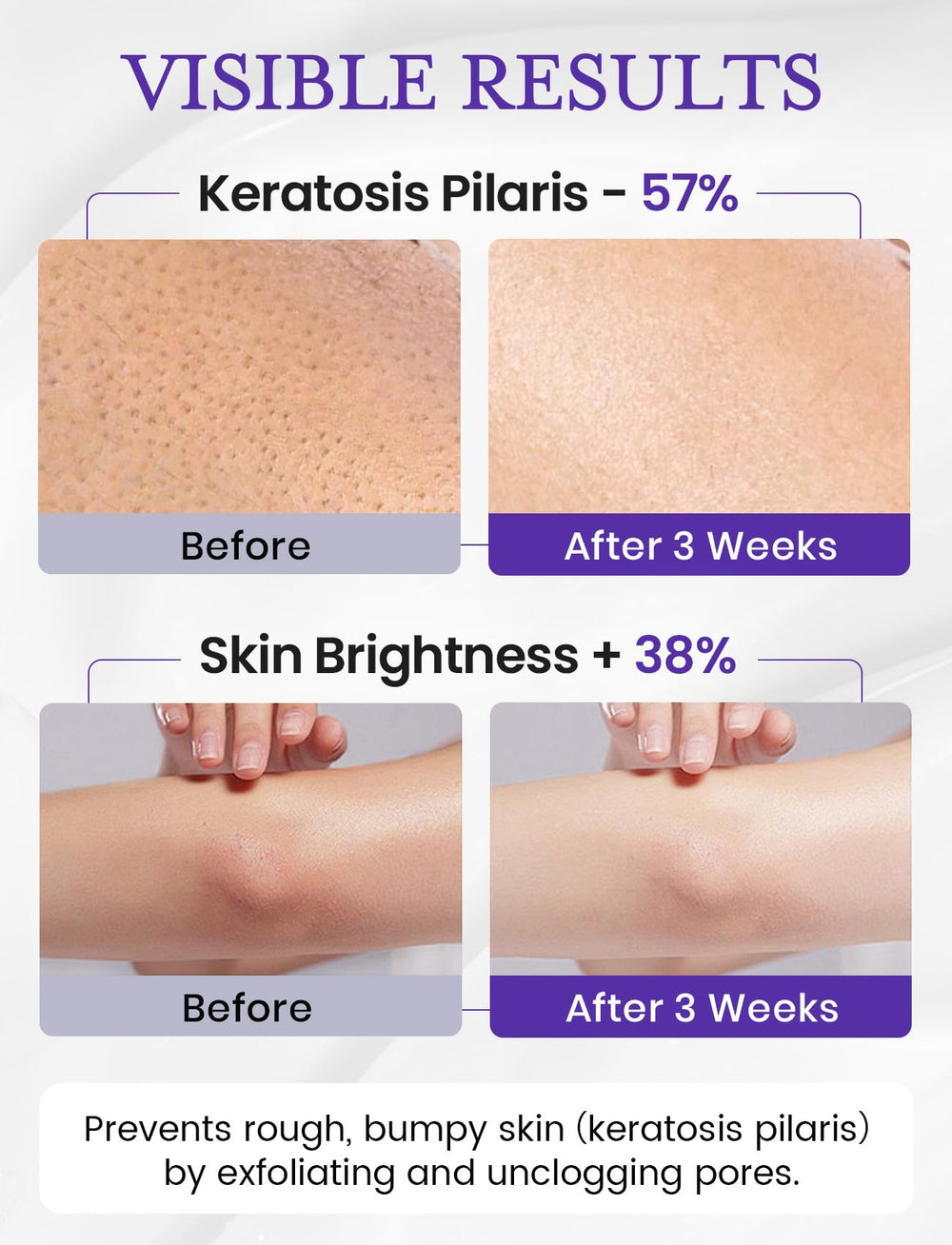 Elvira KP Bump Eraser features Niacinamide and Vitamin C for brighter-looking skin