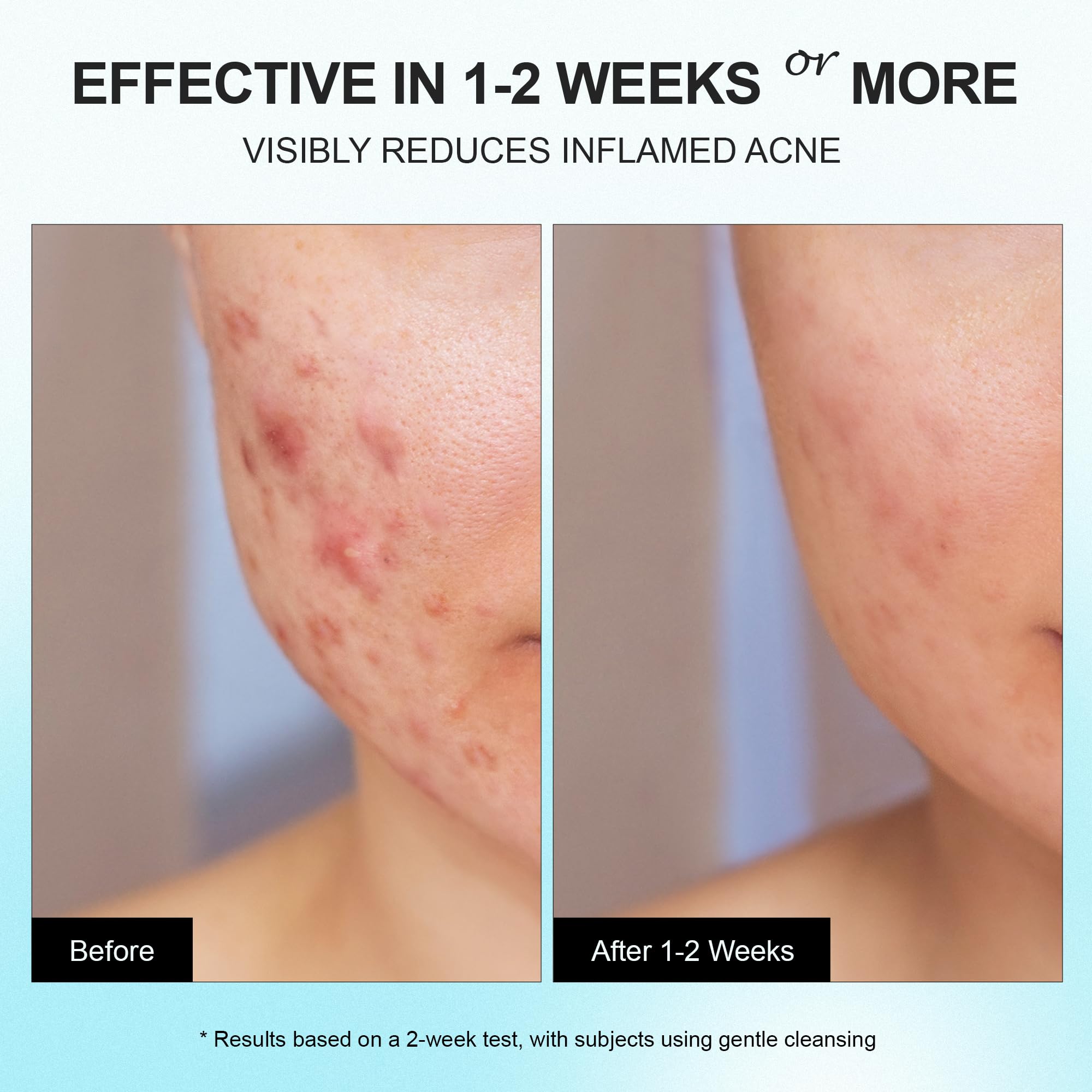 Enaskin Naturals acne-spot treatment on skin demonstrates fast absorption without pilling.