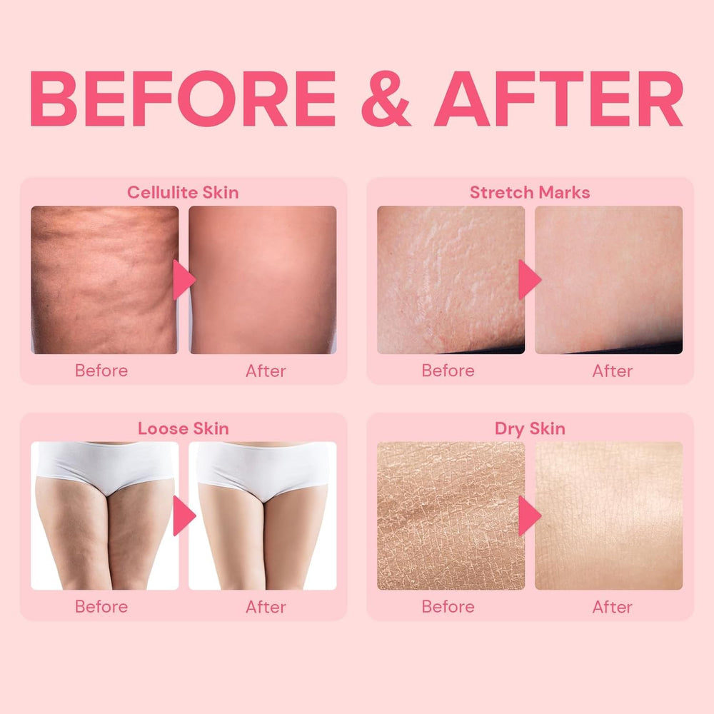 Enaskin Naturals cellulite remover stomach belly lotion shows smoothing around midsection