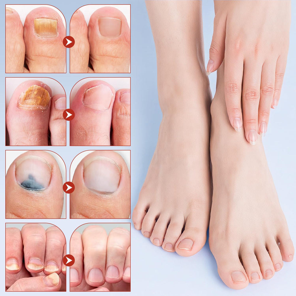 EOIRULA Patch highlight shows potential to reduce nail discoloration over time
