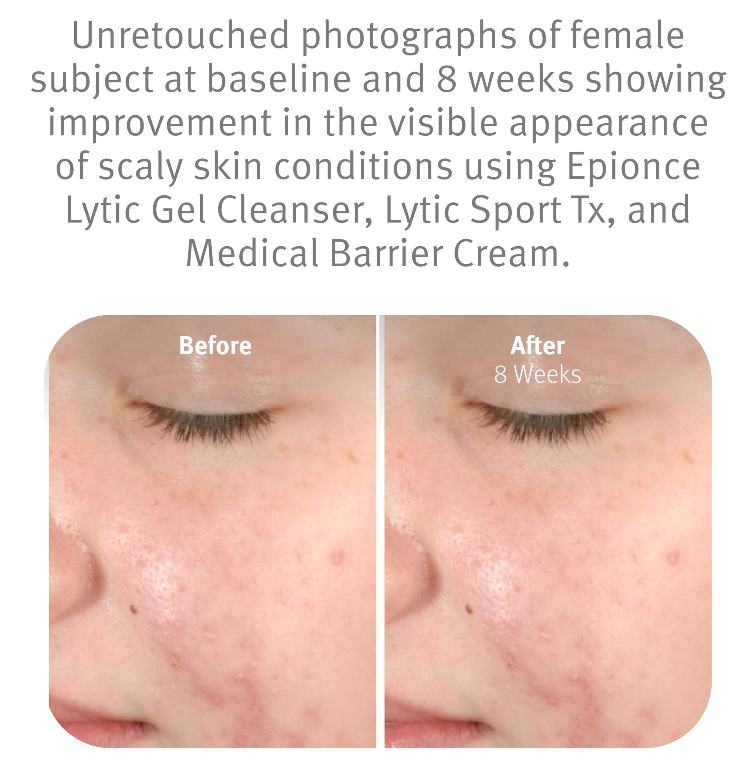 Epionce Lytic Gel Cleanser with willow bark offers gentle exfoliation and clarity