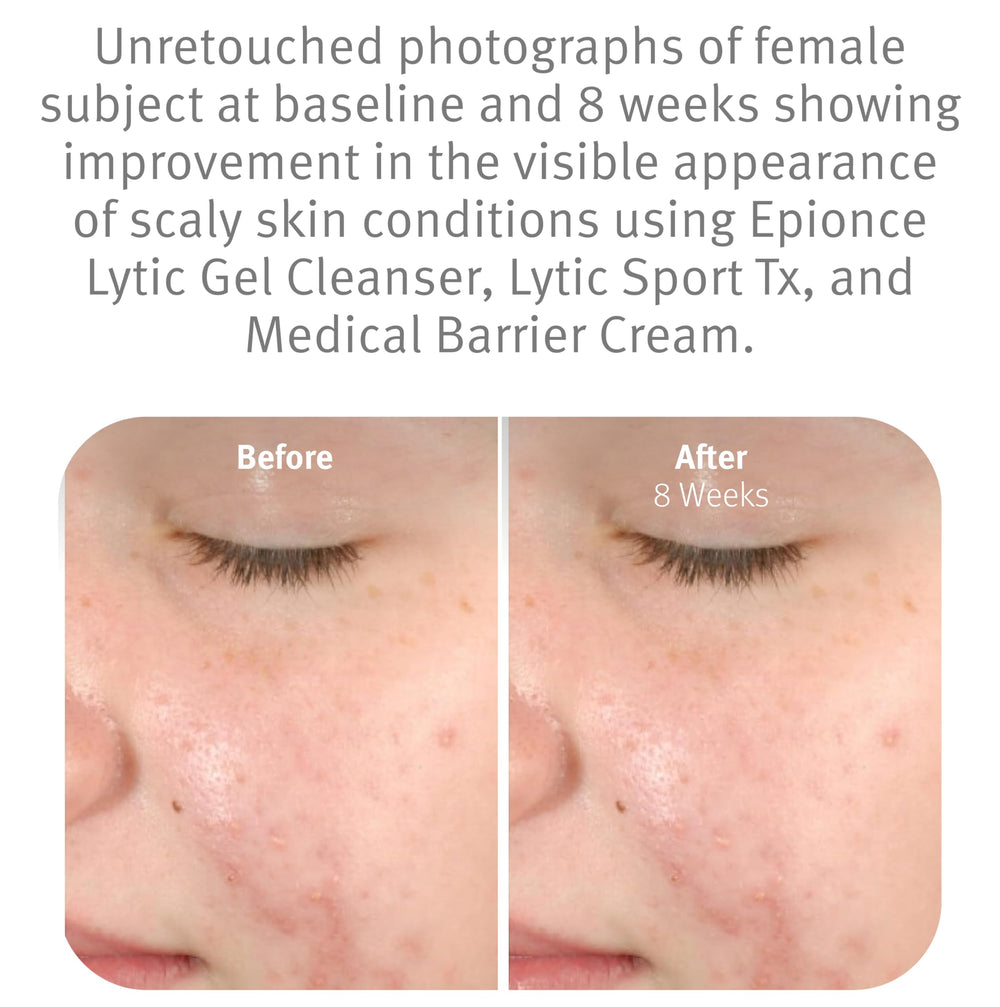 Epionce Lytic Gel Cleanser with willow bark offers gentle exfoliation and clarity