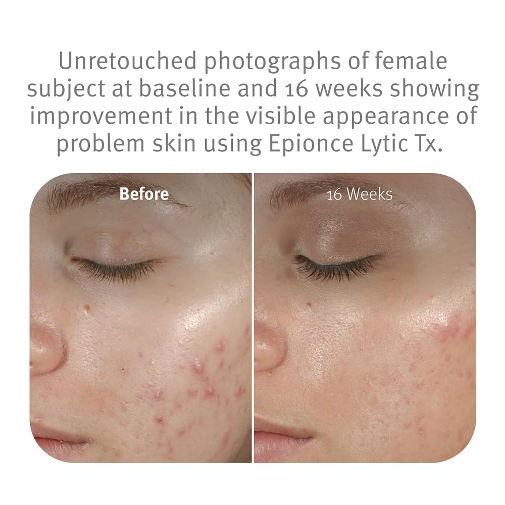 Epionce Lytic Plus Tx ingredients close-up highlighting actives