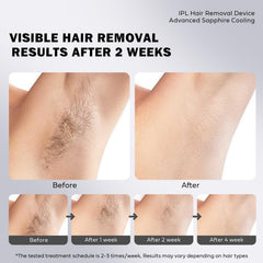 EUARNE lip-area lamp head enables targeted facial hair removal