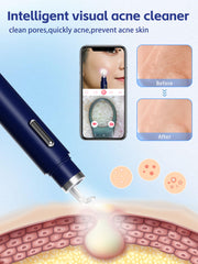 EURART Visual Blackhead Remover 1080p video clarity aids safe extraction