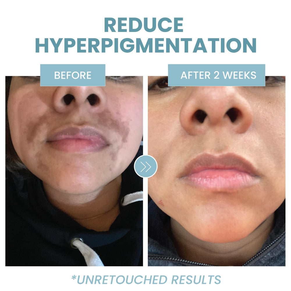 Eva Naturals Azelaic Acid Serum ingredients hyaluronic acid for deep hydration.