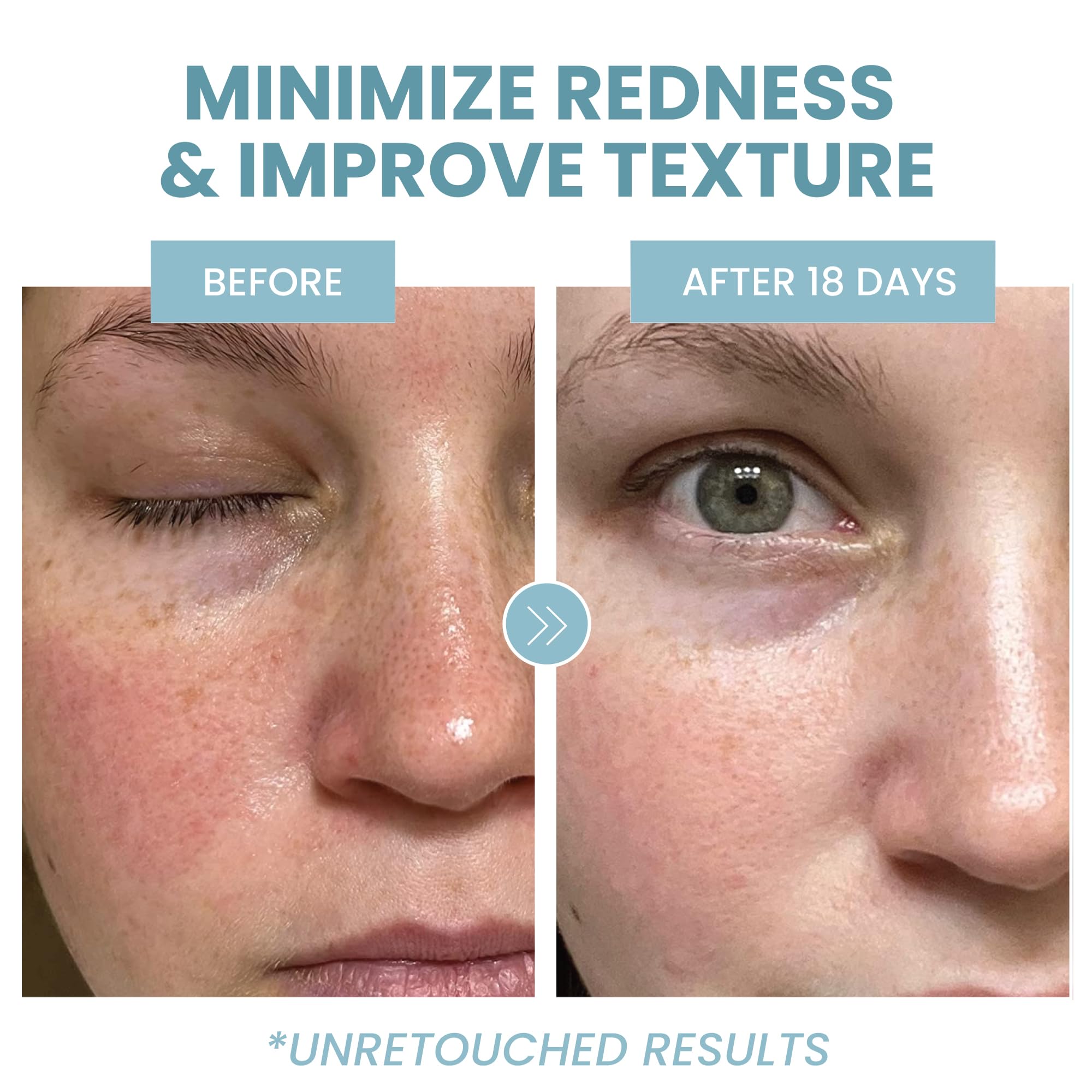 Eva Naturals Azelaic Acid Serum ingredients niacinamide for balanced tone.