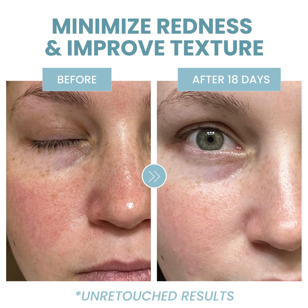 Eva Naturals Azelaic Acid Serum ingredients niacinamide for balanced tone.