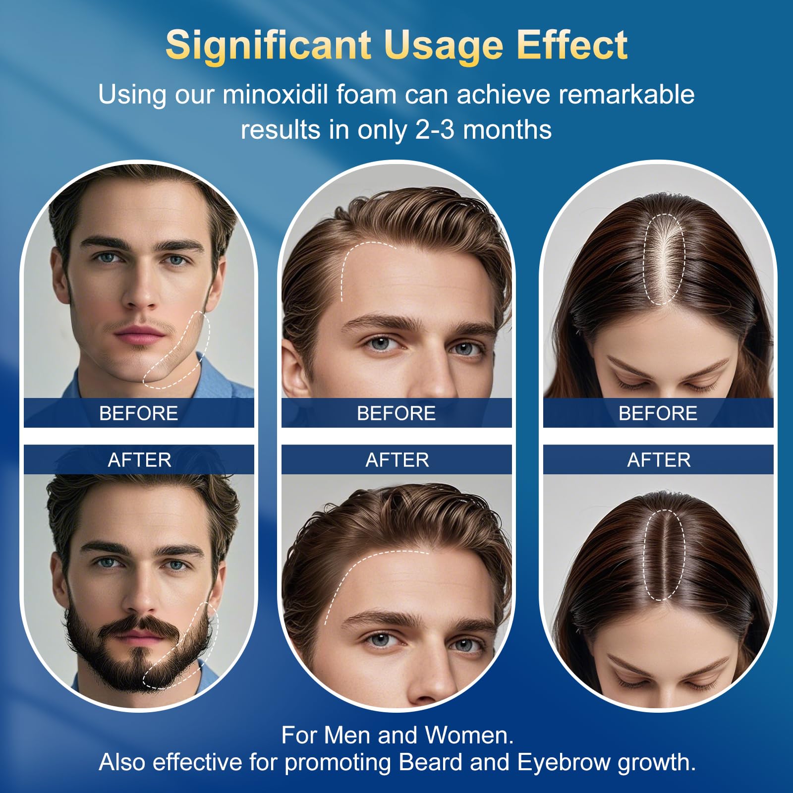 ExDeploy minoxidil foam closeup reveals creamy texture for precise application