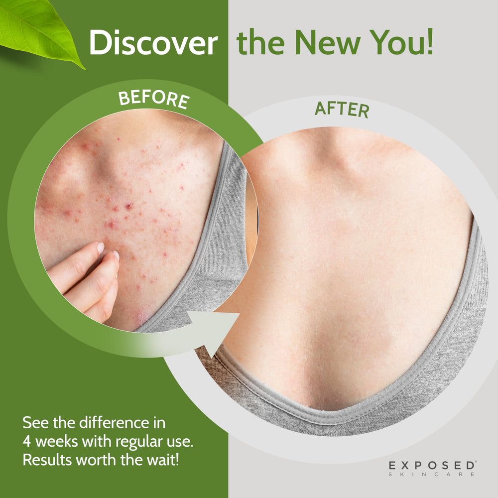 Exposed Skin Care back area application highlights targeted cleansing for bacne-prone zones.