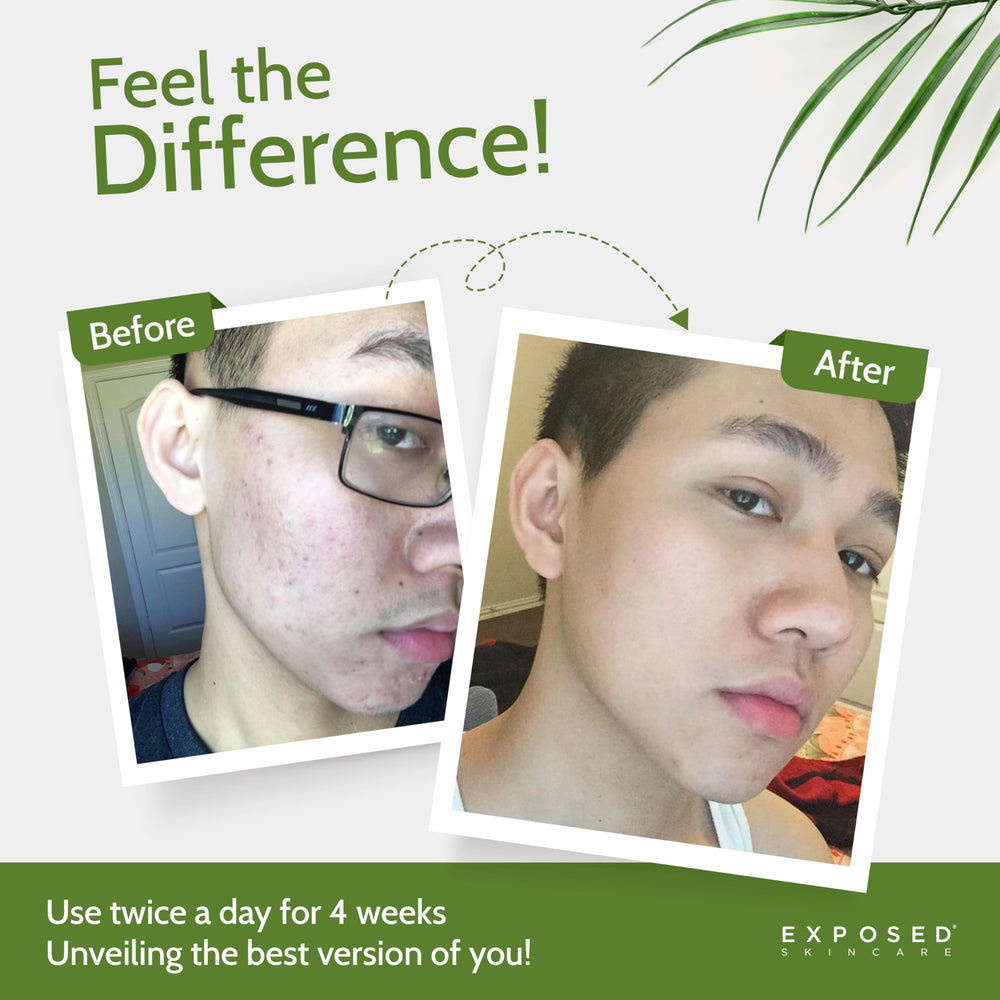 Exposed Skin Care five-piece kit layout showcases complete acne routine
