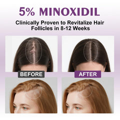 EZBIORT minoxidil application on scalp for targeted hair growth