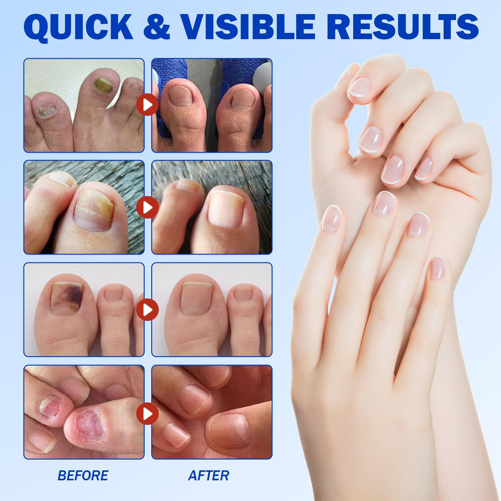 FANSHI patches on toe nail overnight repair with secure adhesion.
