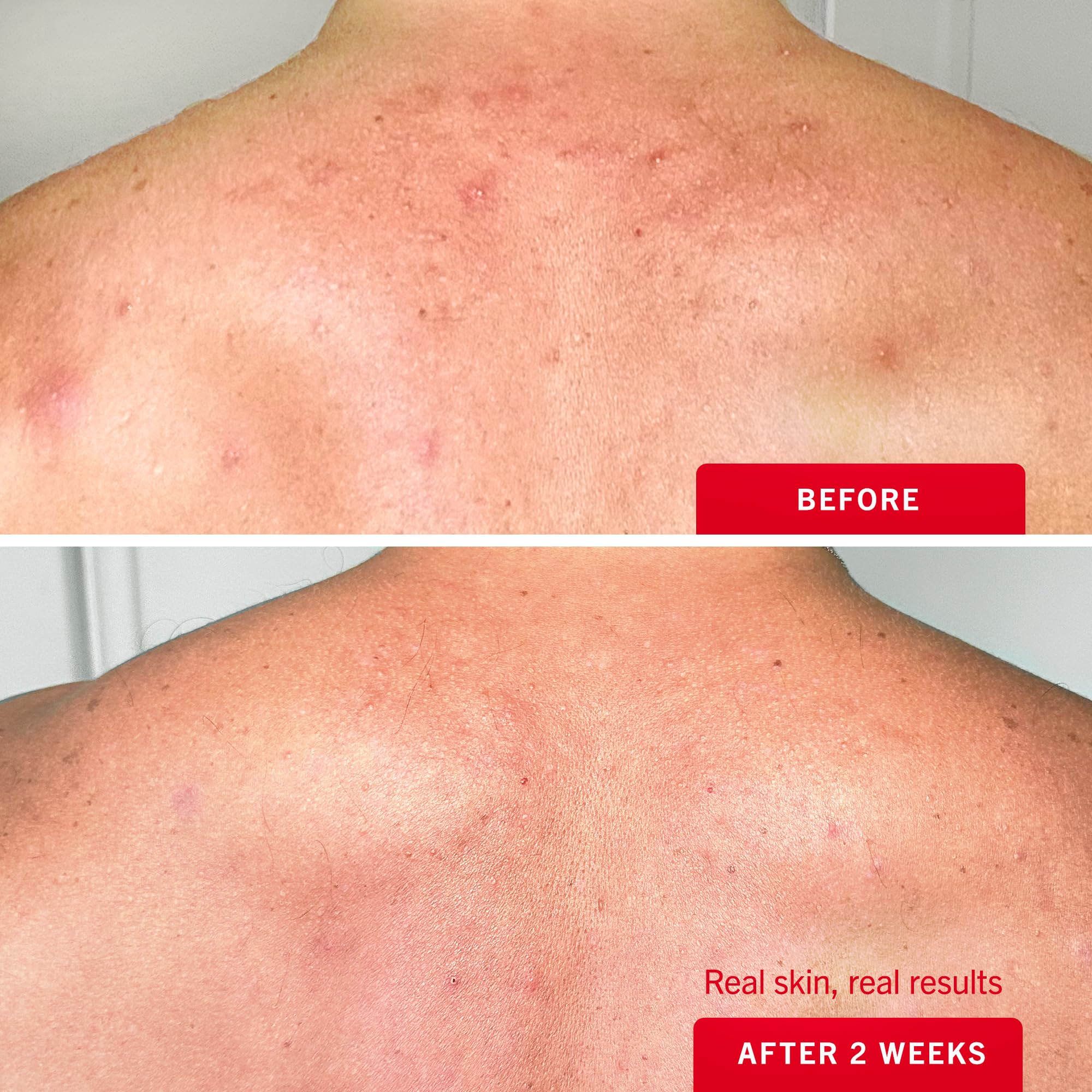 First Aid Beauty with glycerin hydrates and soothes sensitive skin during treatment