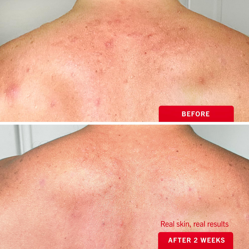 First Aid Beauty with glycerin hydrates and soothes sensitive skin during treatment