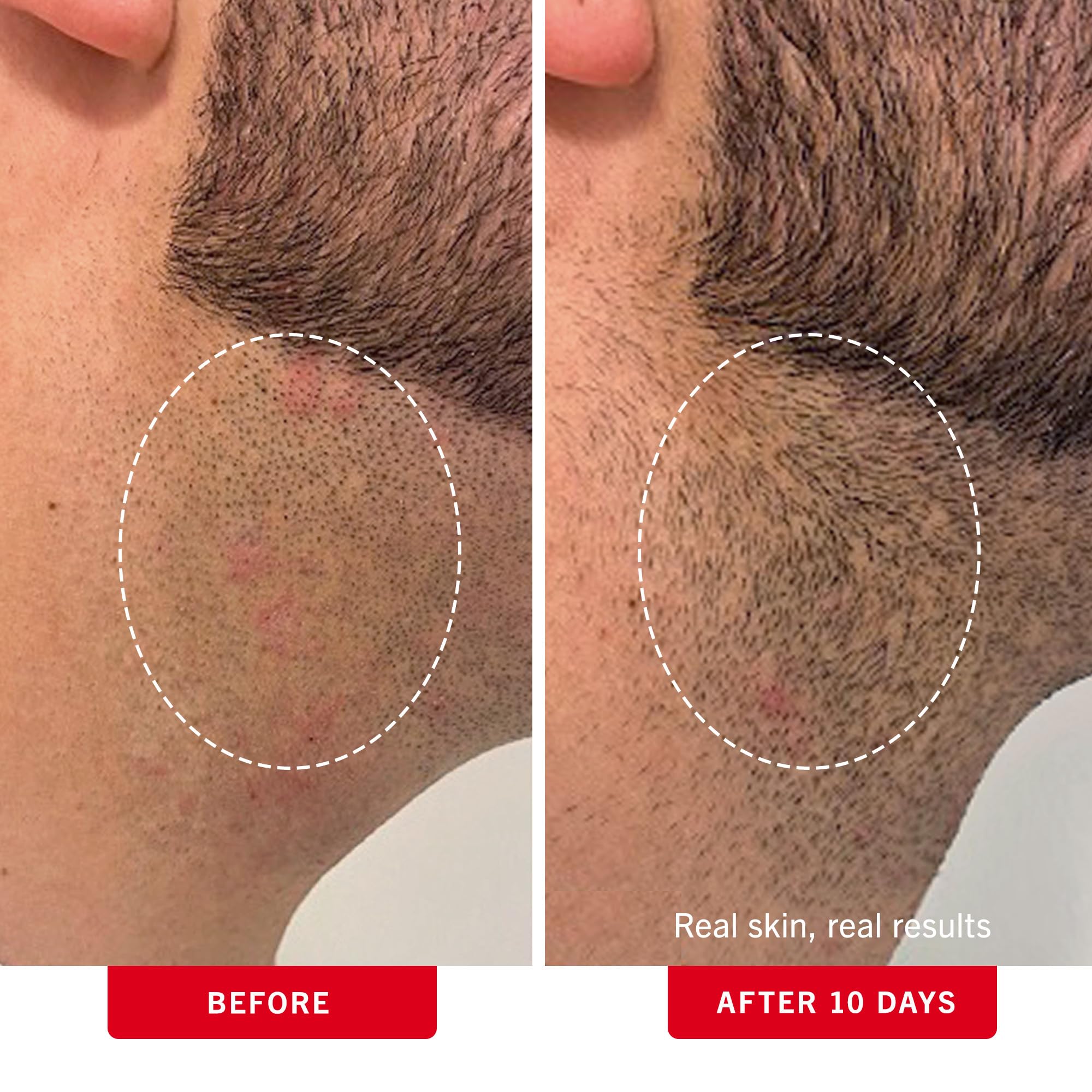 First Aid Beauty Ingrown Hair Pads applied after shaving for smoothing relief.