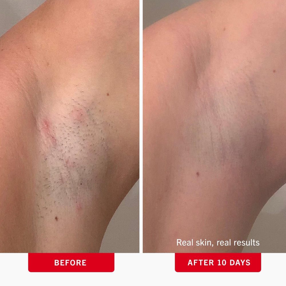 First Aid Beauty ingrown hair pads face application demonstrates gentle post-shave swipe.