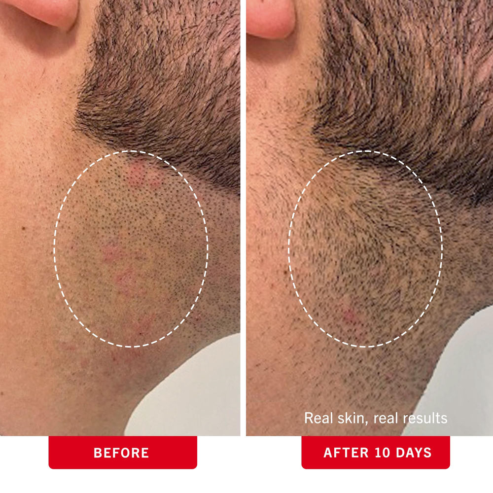 First Aid Beauty ingrown hair pads underarms area ideal for post-shave skin care.